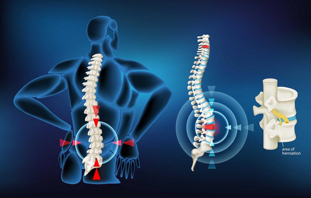 slipped disc